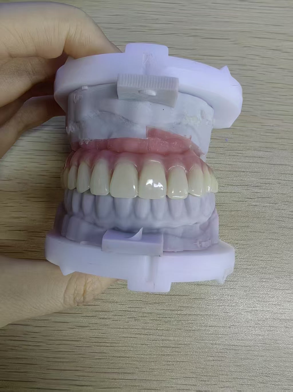 An Acrylic Denture With A Titanium Bar (Ti-Bar) Cost-Effective Full Arch Restoration Screw Retained