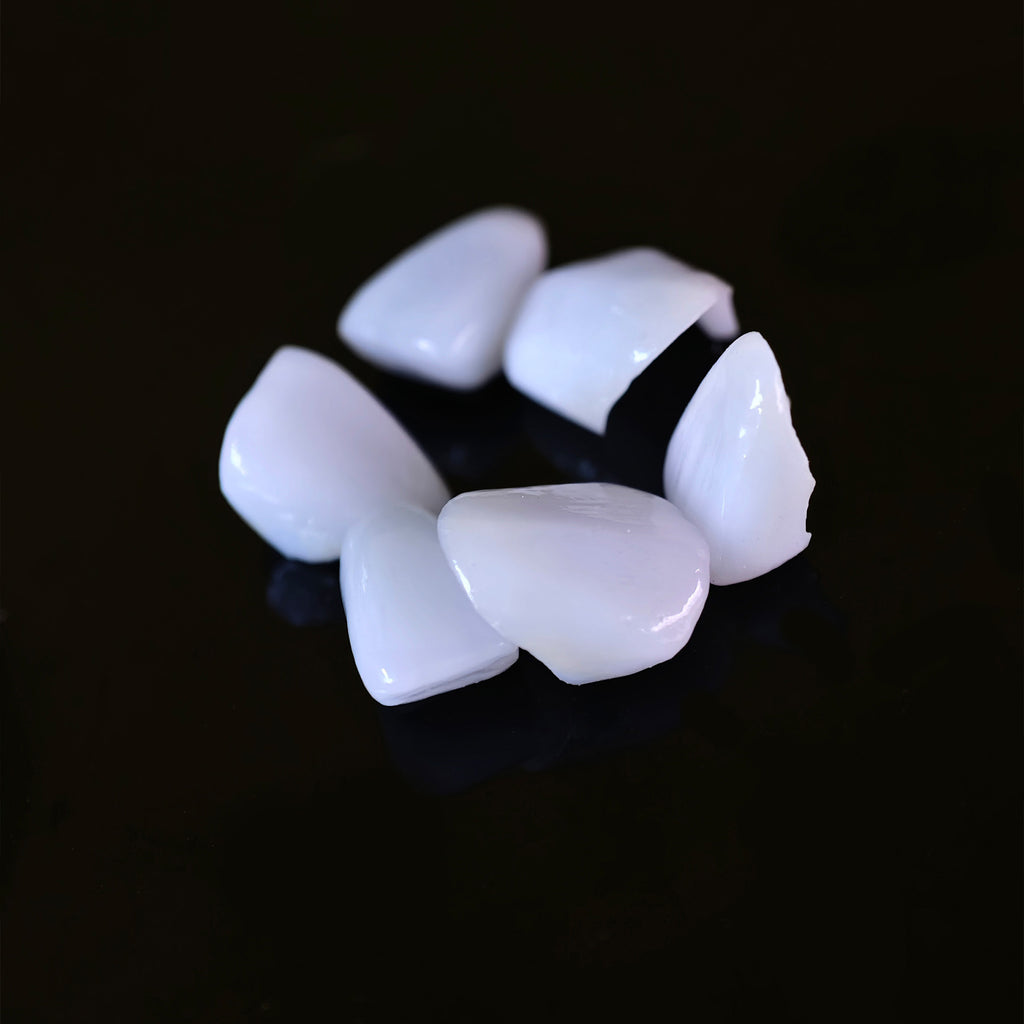 Ceramic Veneers And Crown With Cement Retained