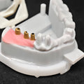 Co - Cr PFM Dental Bridge