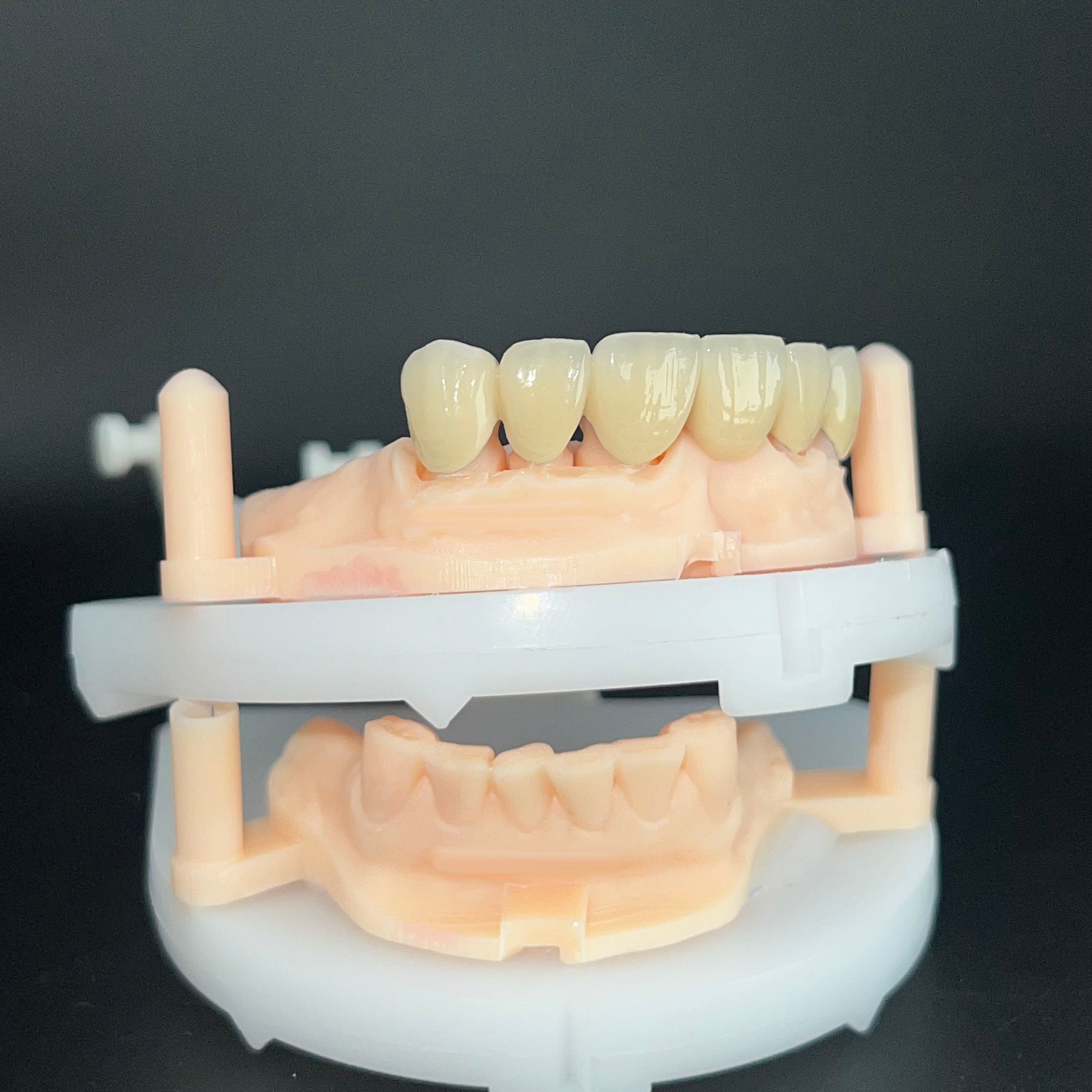 Co - Cr PFM Dental Bridge