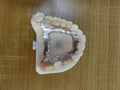 Cobalt Chrome Framework Denture Metal Framework With Acrylic Denture