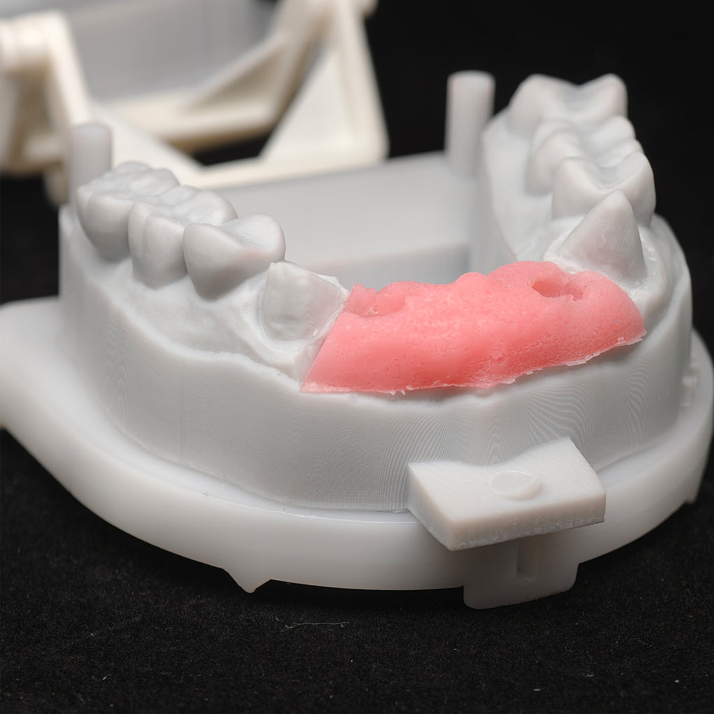 Custom Zirconia Implant Bridge