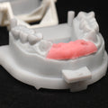Custom Zirconia Implant Bridge