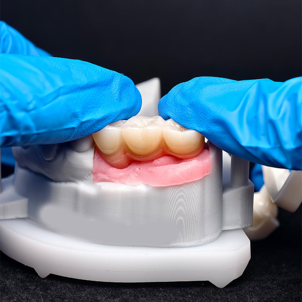 Custom Zirconia Implant Bridge