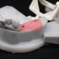 Custom Zirconia Implant Bridge