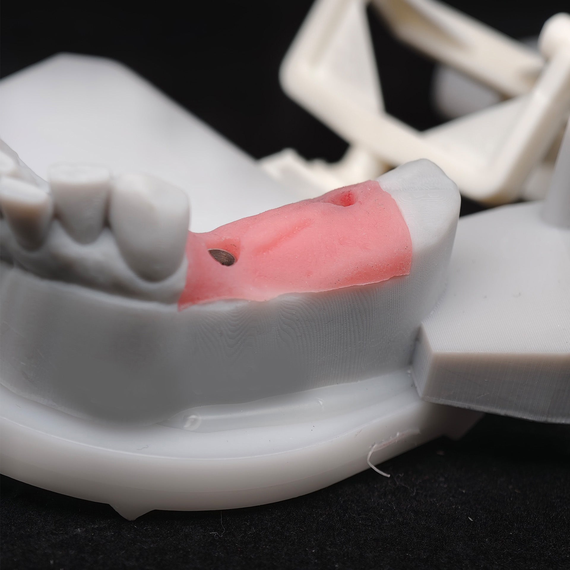 Custom Zirconia Implant Bridge