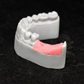Custom Zirconia Implant Bridge