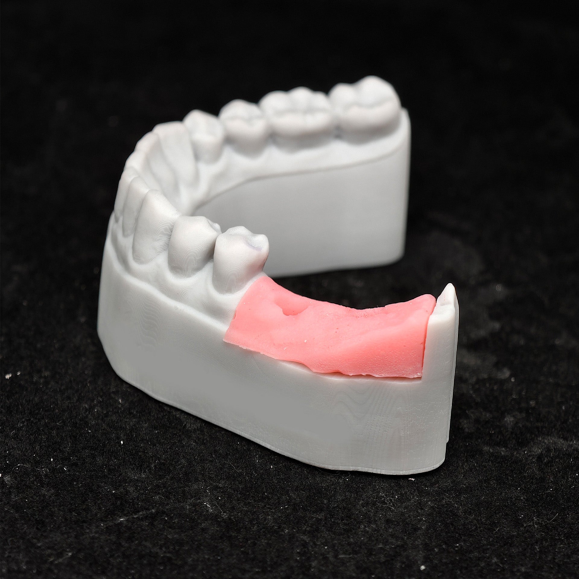 Custom Zirconia Implant Bridge