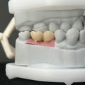 Custom Zirconia Implant Bridge