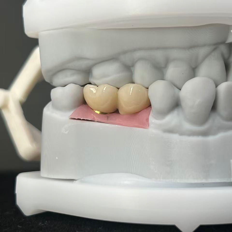 Custom Zirconia Implant Bridge