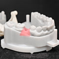Custom Zirconia Implant Crown