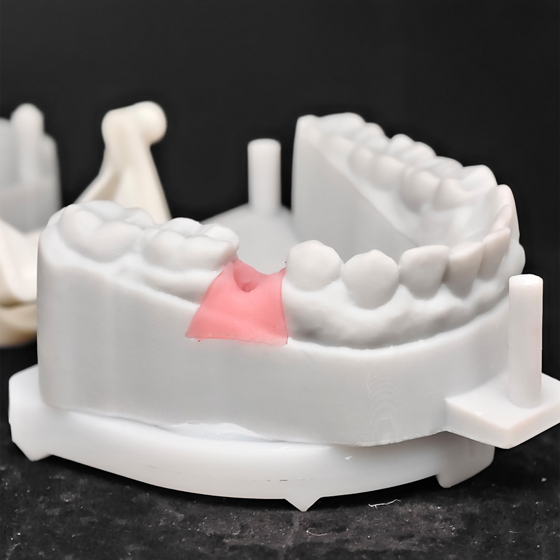 Custom Zirconia Implant Crown