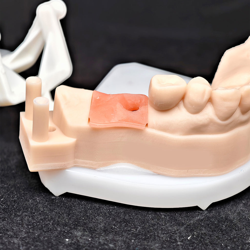 Custom Zirconia Implant Crown