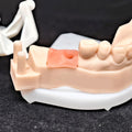 Custom Zirconia Implant Crown