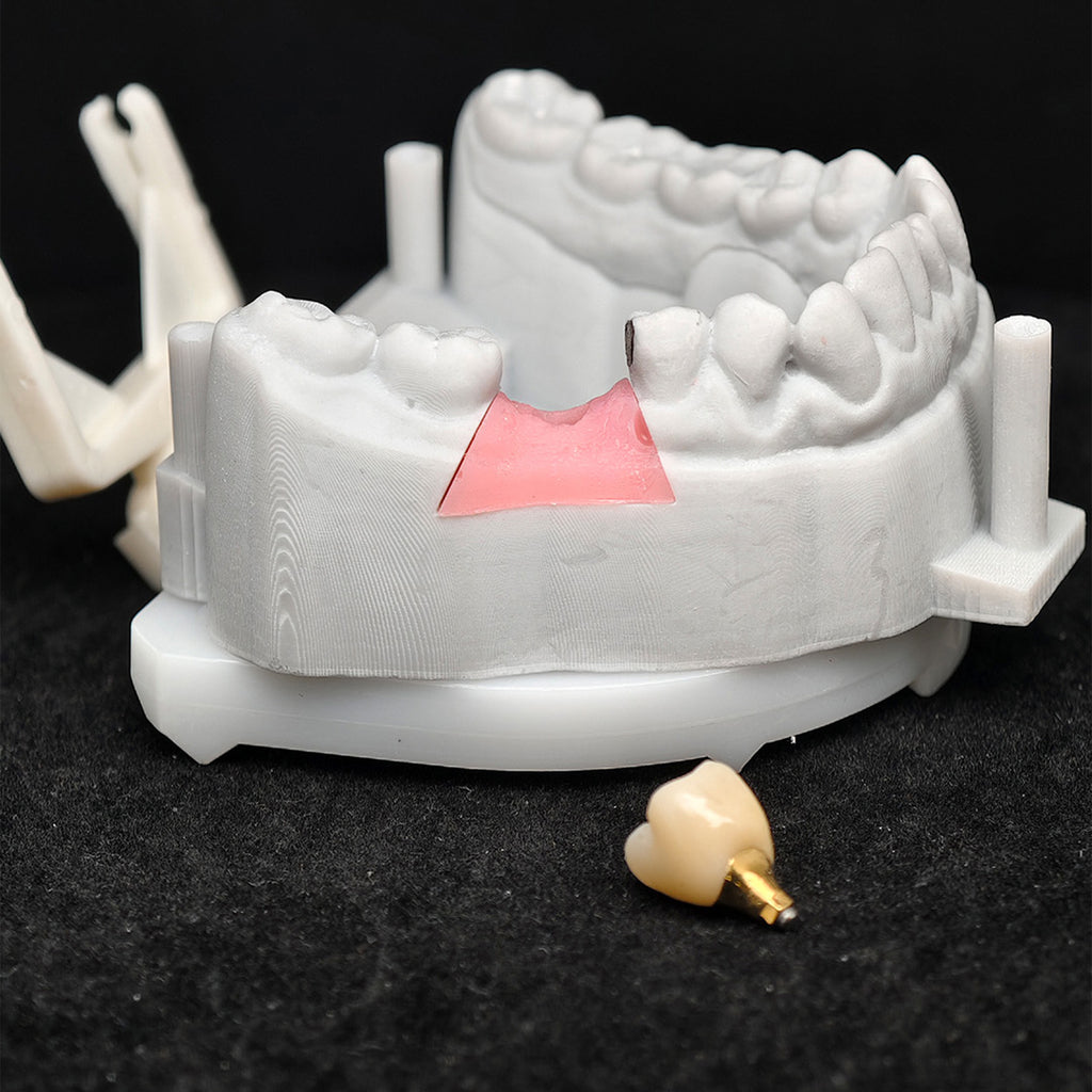 Custom Zirconia Implant Crown