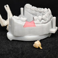 Custom Zirconia Implant Crown