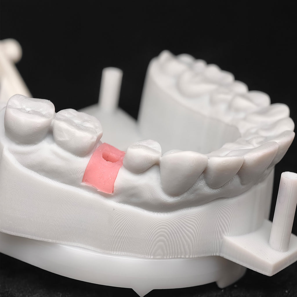 Custom Zirconia Implant Crowns
