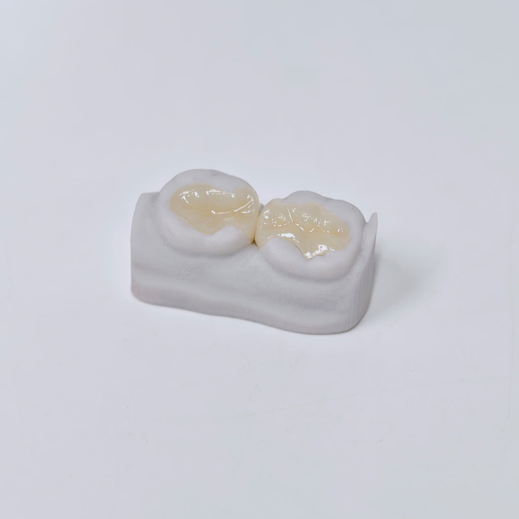 E.Max Inlay/Onlay