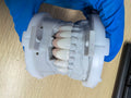 E.Max Implant Crown With Custom Abutment