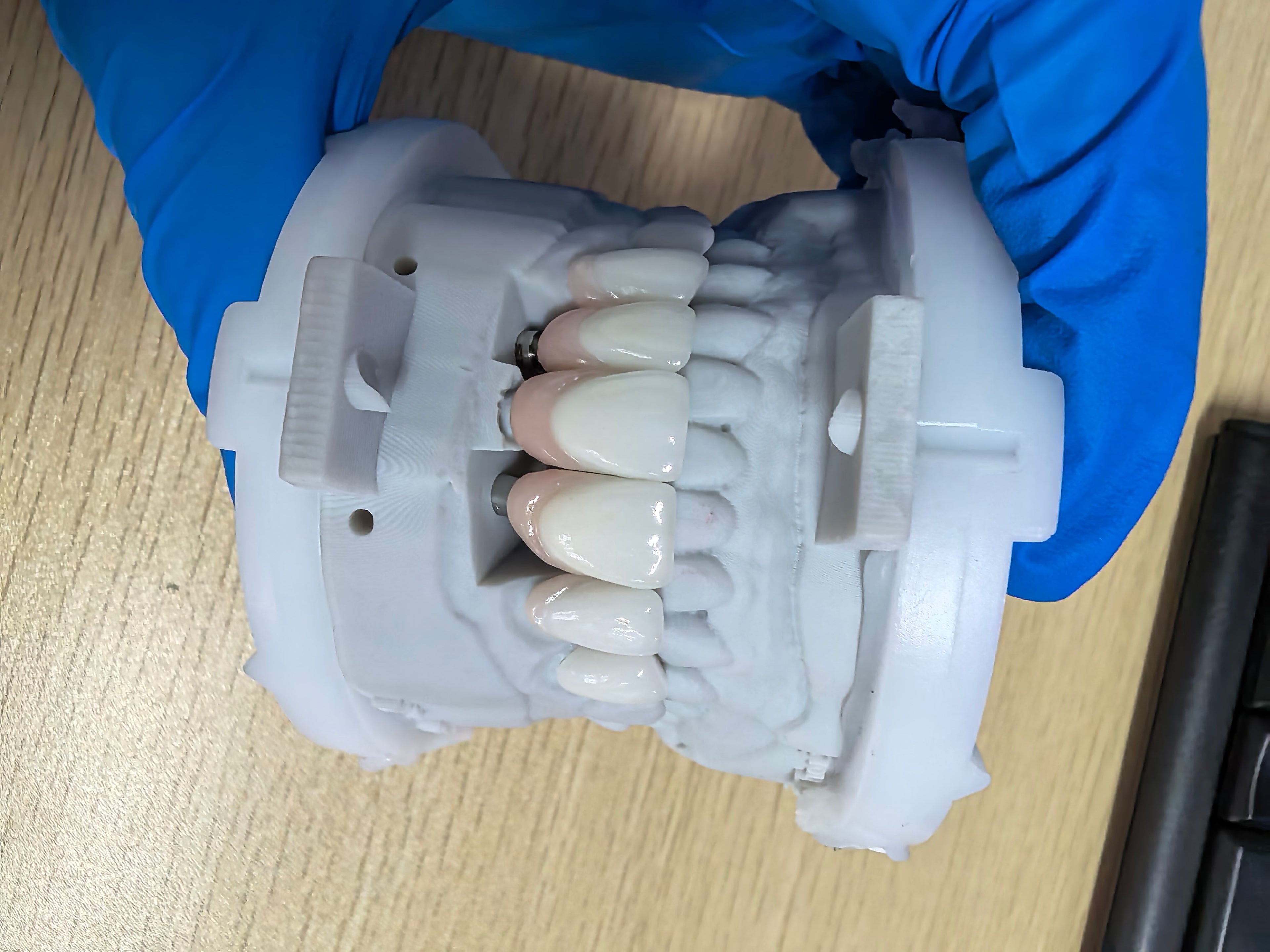 E.Max Implant Crown With Custom Abutment