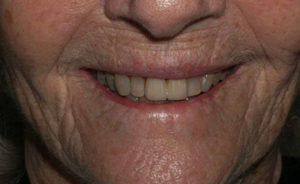 Emax With Porcelain Powder High Aesthetics