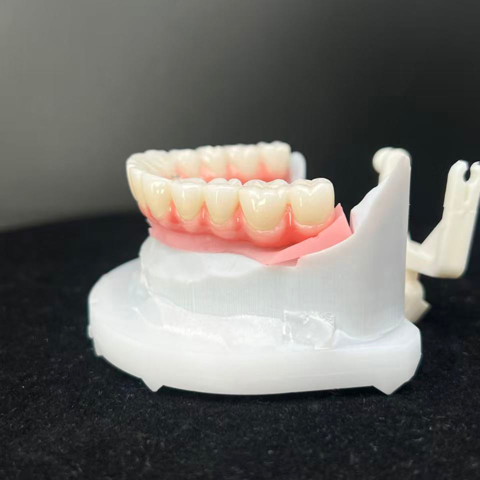 Enhanced Zirconia Crown Malo Bridge