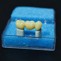 High - Strength Zirconia Bridge