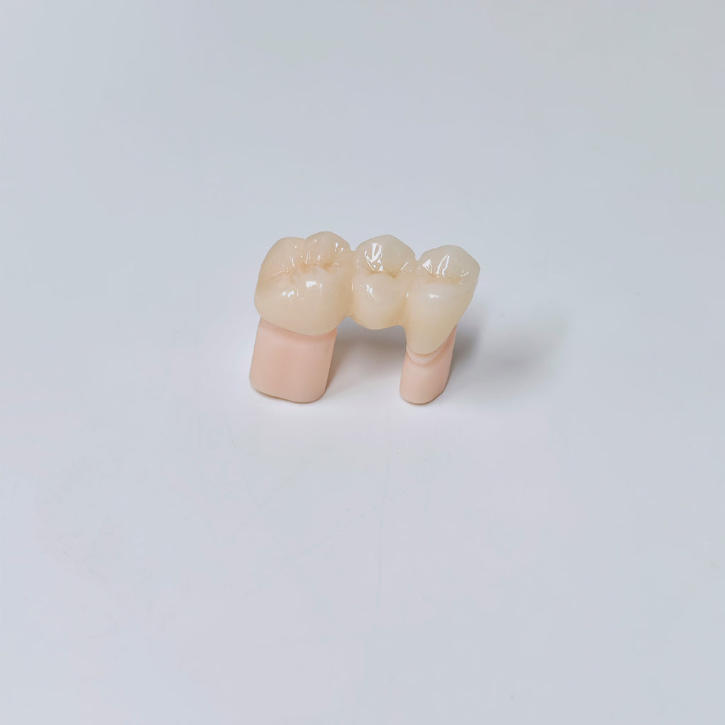 High - Strength Zirconia Bridge