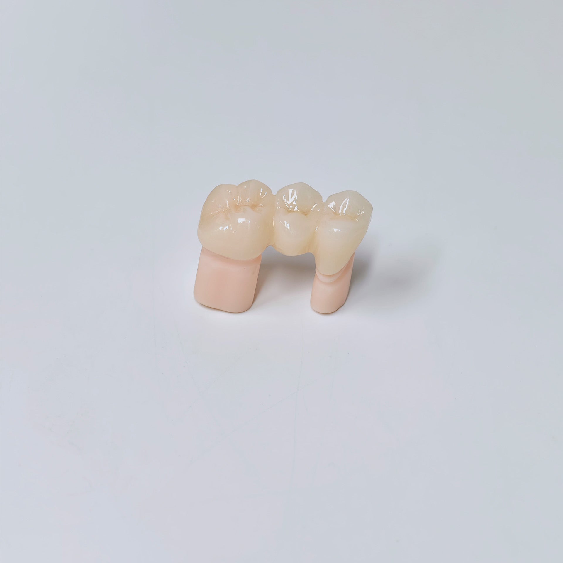High - Strength Zirconia Bridge