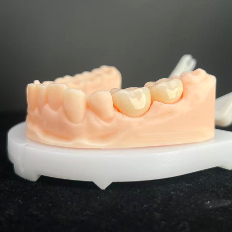 High - Strength Zirconia Dental Crowns