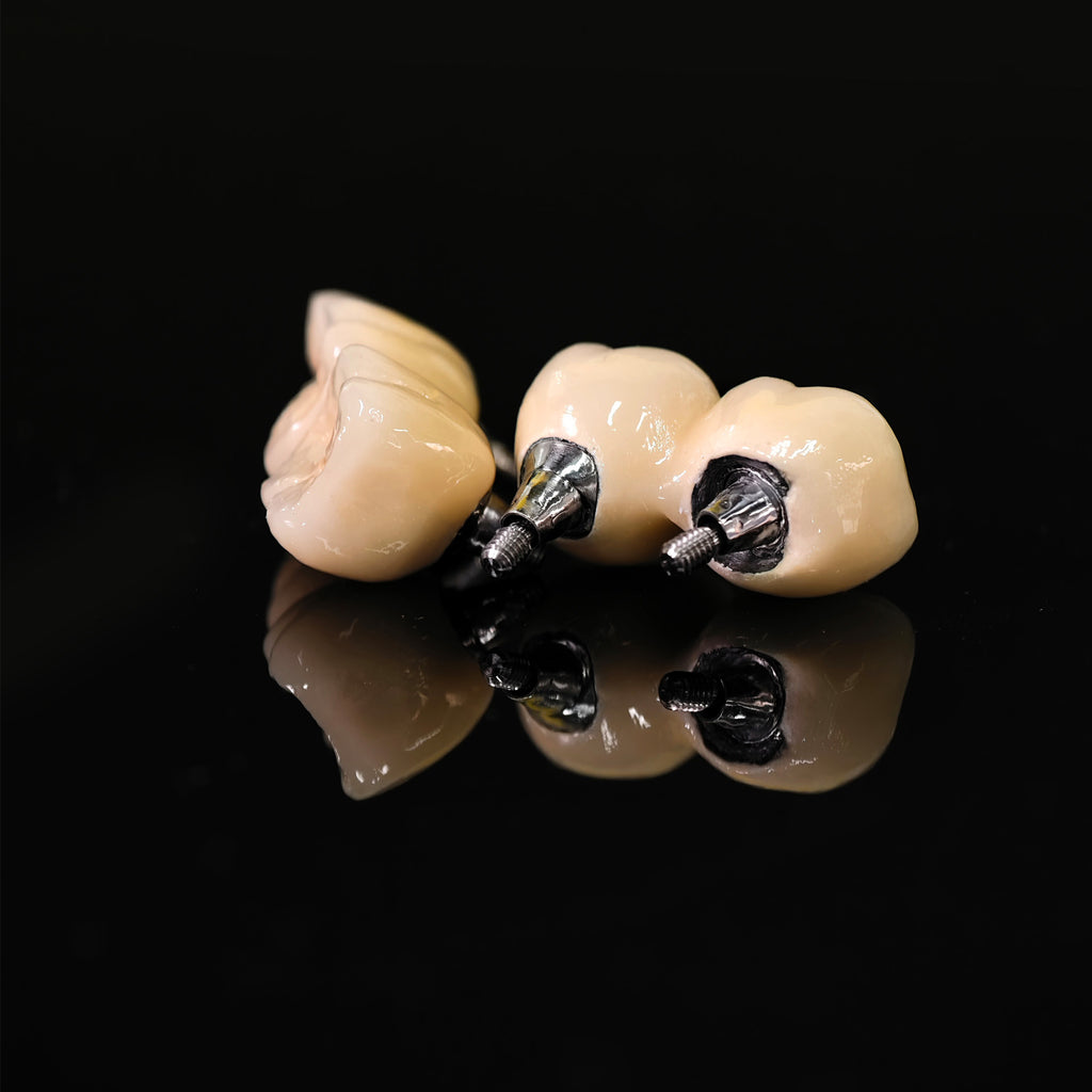 Implant-supported Co - Cr PFM Dental Bridge