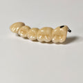 Implant-Supported PFM Single Bridge