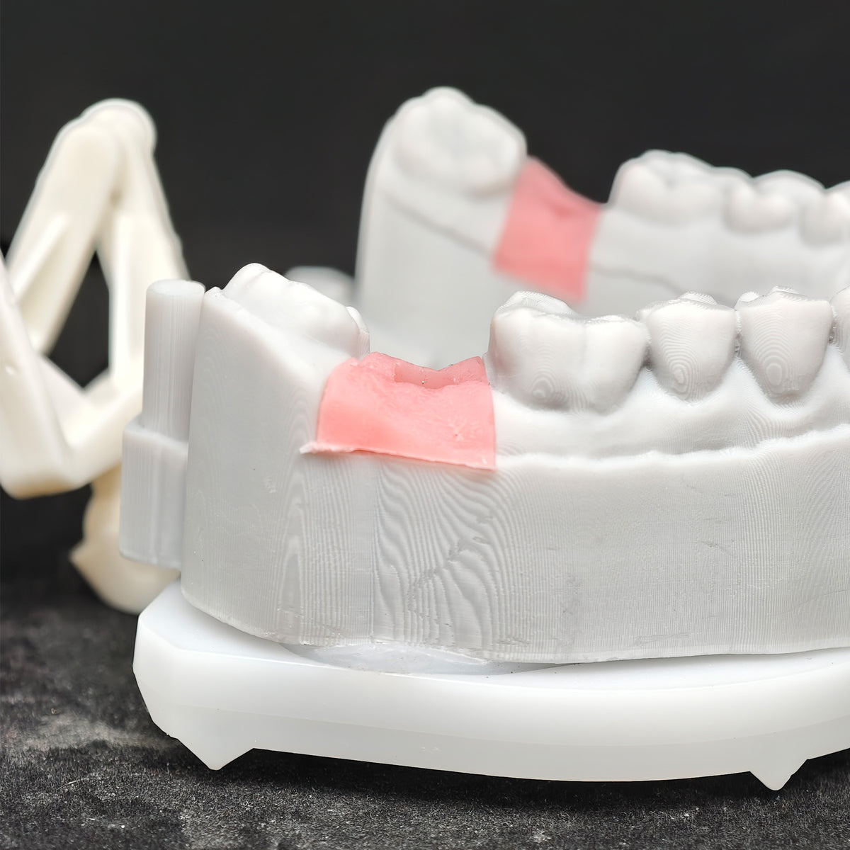 Implant-Supported PFM Single Crown With Metal