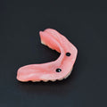 Locator Overdenture Implant Acrylic Denture Restoration