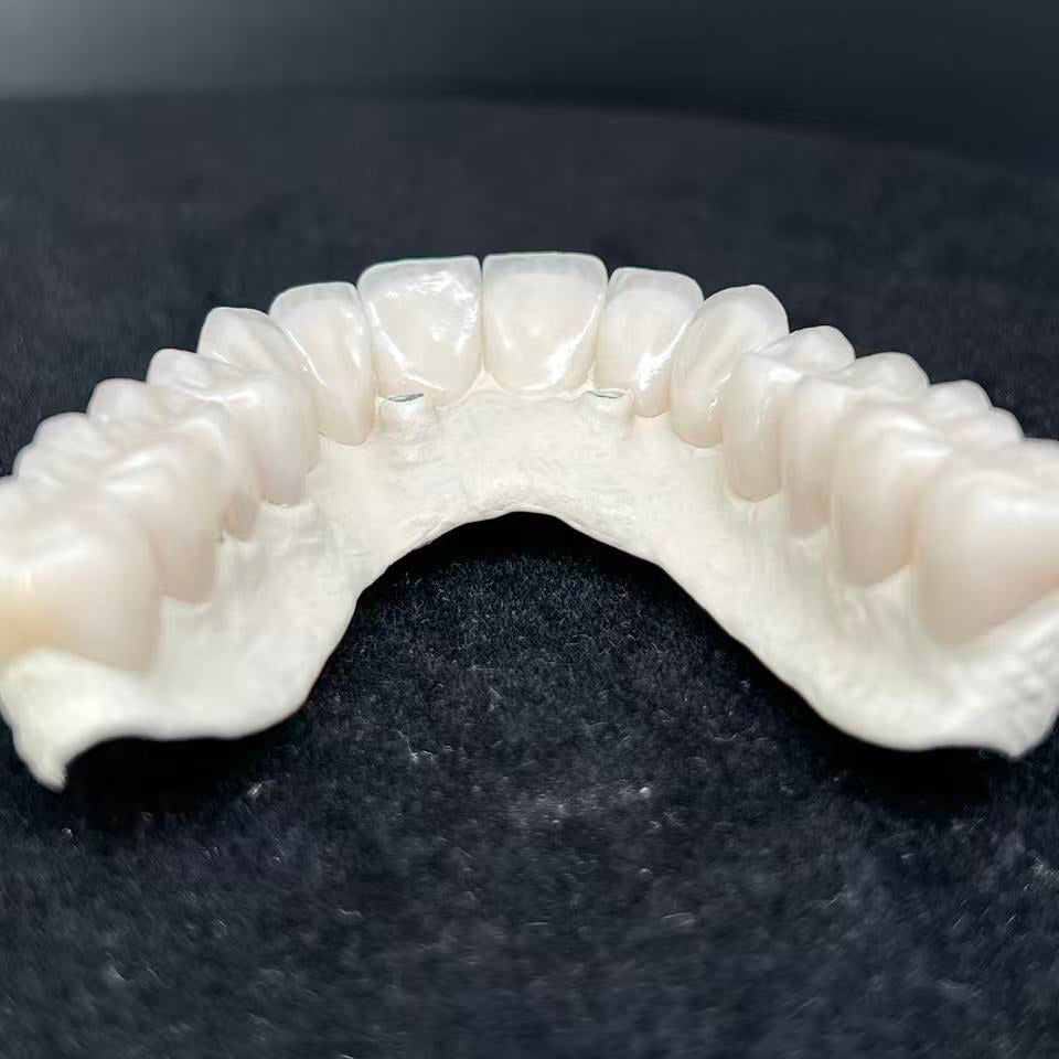 Malo Bridge Implant Restorations