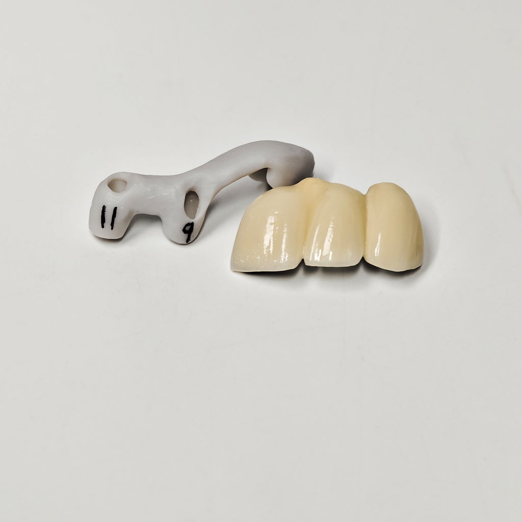 PFM Bridge With Screw-Retained And Implant Seating Guide