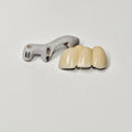 PFM Bridge With Screw-Retained And Implant Seating Guide