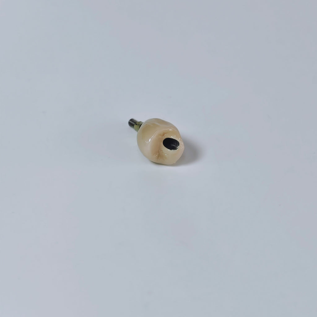 PFM Crown With Screw Retained