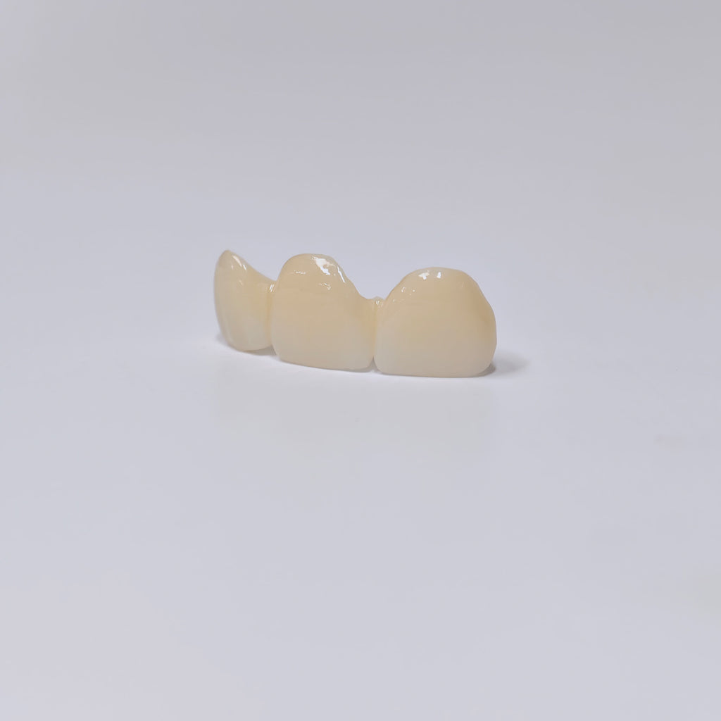 PFZ Dental Bridge – Depth And Aesthetics