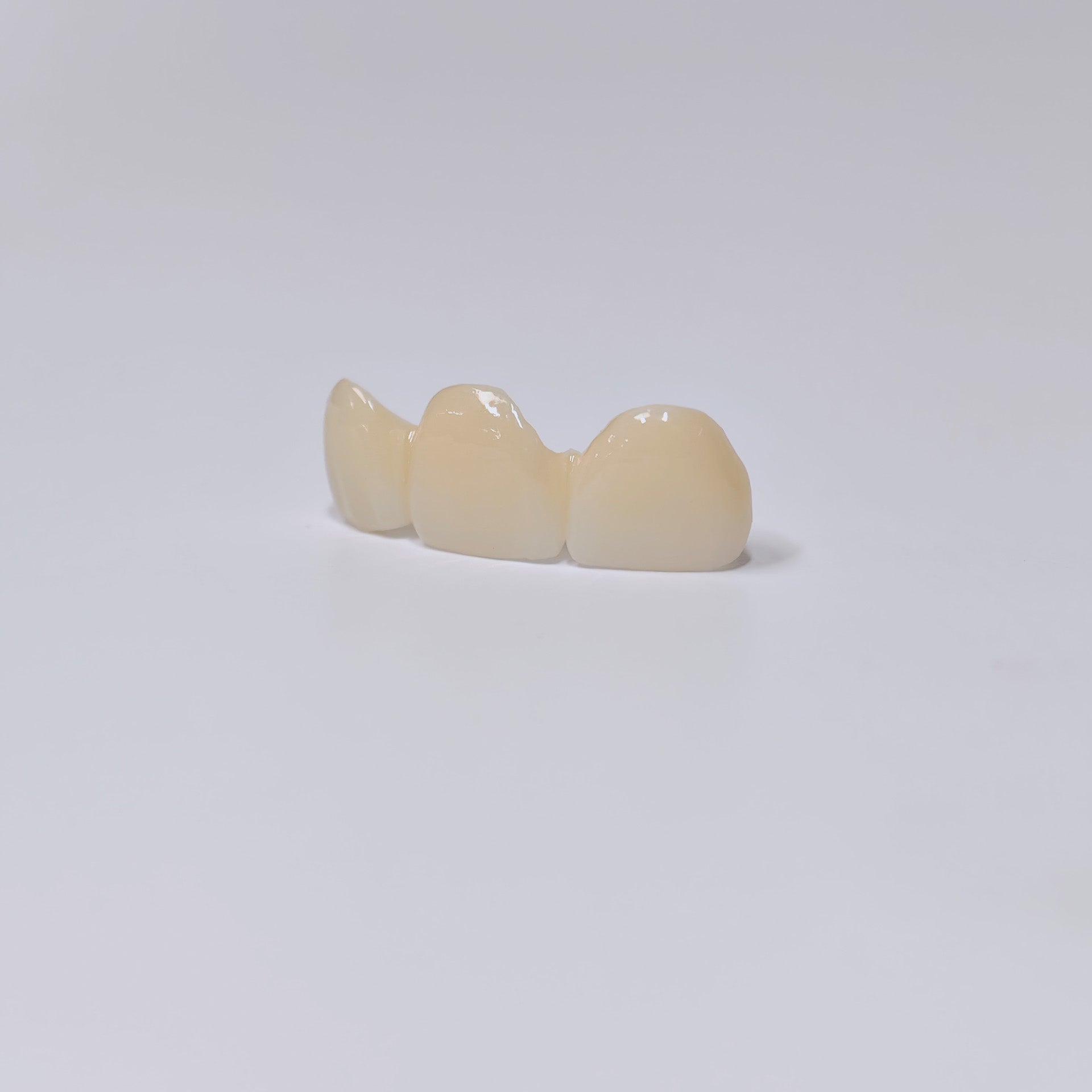 PFZ Dental Bridge – Depth And Aesthetics