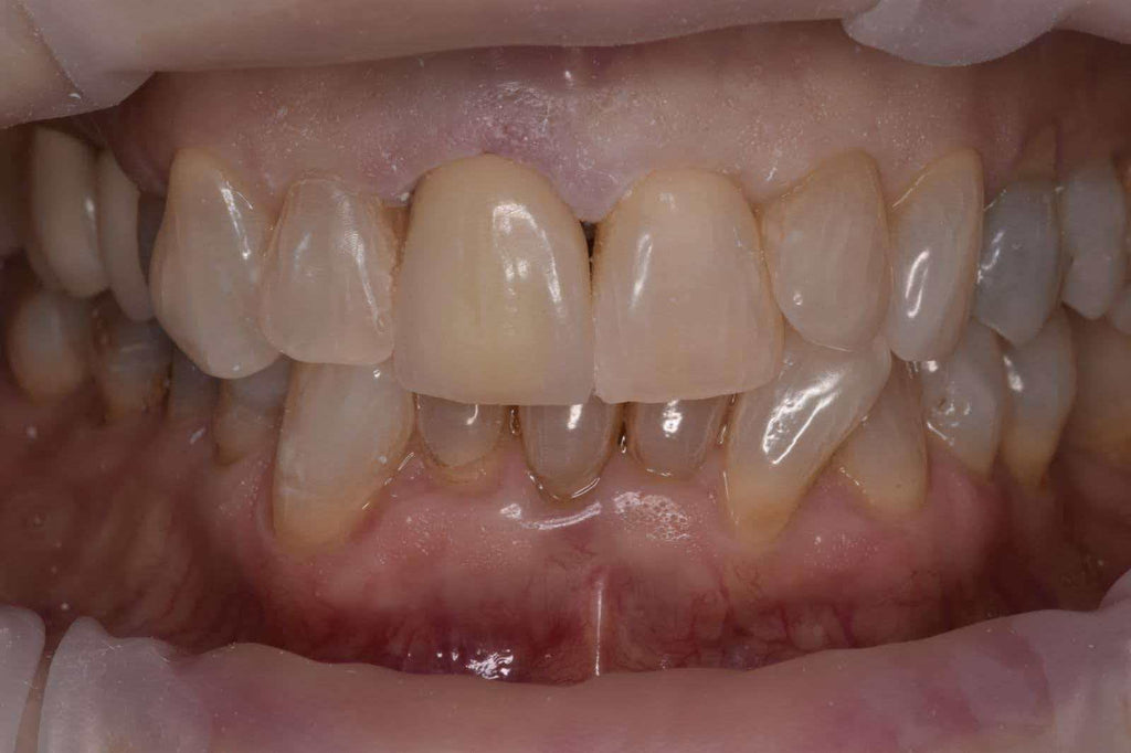 PFZ High Aesthetics Crown Dental Lab