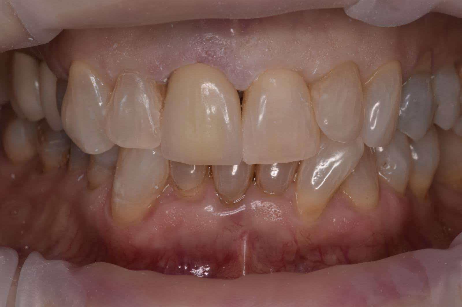 PFZ High Aesthetics Crown Dental Lab