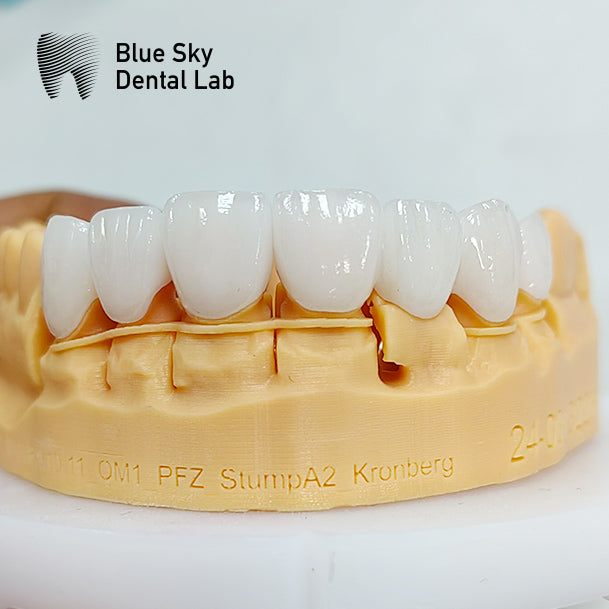 PFZ Porcelain Fused Zirconia Aidite Zirconia Affordable Dental Lab