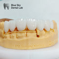 PFZ Porcelain Fused Zirconia Aidite Zirconia Affordable Dental Lab
