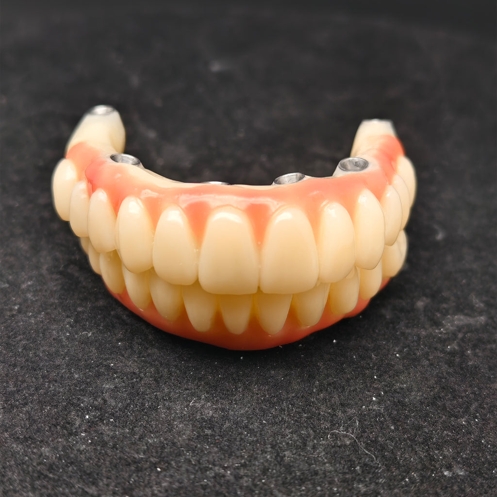 PMMA Bridge With Ti-Base Screw Retained Trying For Full Arch Restoration