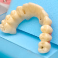 PMMA Bridge With Ti-Base Screw Retained Trying For Full Arch Restoration