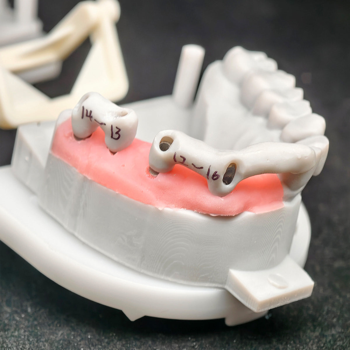 PMMA Bridge With Custom Abutment And Implant Seating Guide