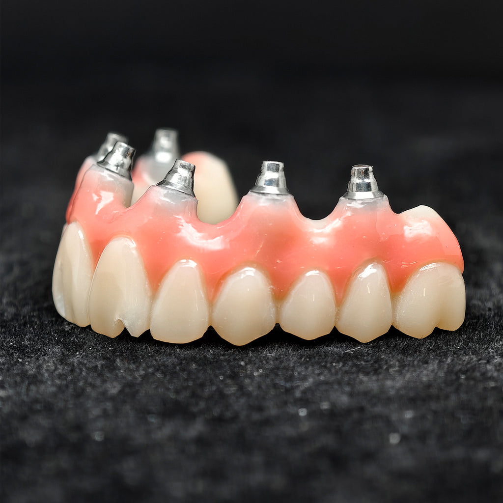 Pmma Bridge With Screw-Retained