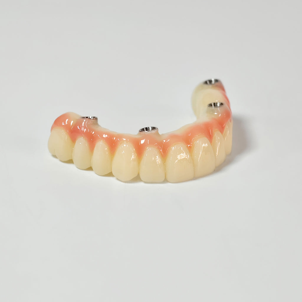 PMMA Bridge With Screw Retained