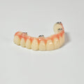 PMMA Bridge With Screw Retained